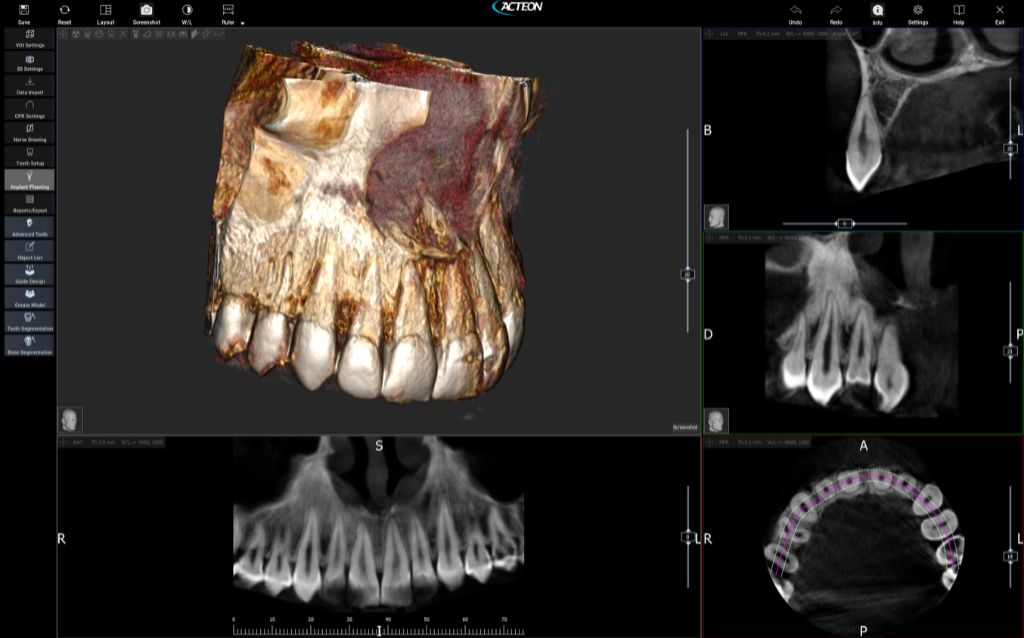 A 2D and 3D scan of a person's jaw using the Acteon X Mind Prime dental x-ray