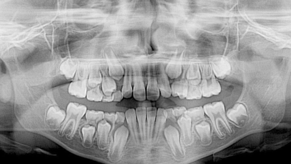 A panoramic x-ray of a person's teeth and jaw taken by the Acteon X Mind Prime CBCT x-ray machine