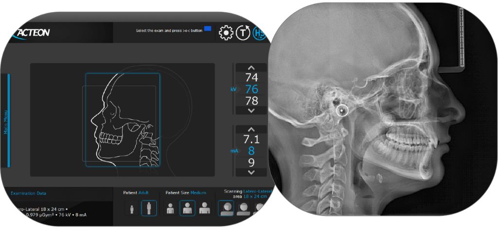 A photo of the Acteon X Mind Prime's software and an x-ray of the side of a person's head
