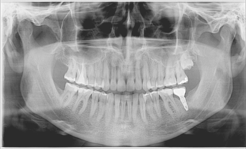 A panoramic x-ray of a person's jaw using the Acteon X Mind Prime with CEPH