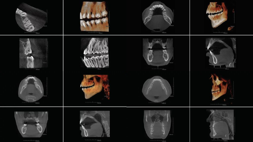 Comparison x-rays of a patient's jaw showing different fields of view using the PreXion Explorer Pro CBCT