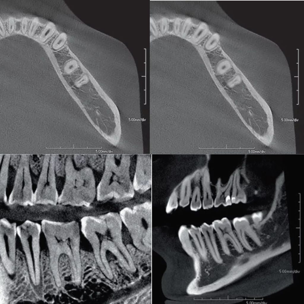 An x-ray of a person's teeth comparing the PreXion Explorer Pro's field of view, focal points, and voxel size