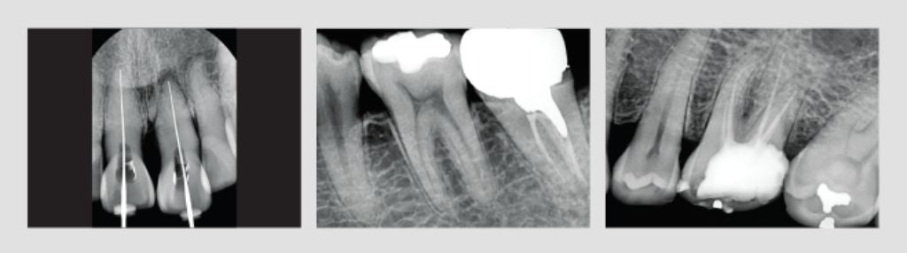 Multiple x-rays of a persons' teeth using the VaTech HD Sensor