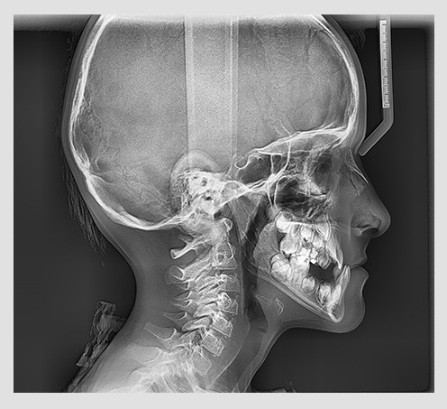 A side view of a black and white full lateral X-ray of a person's head using the Vatech PaX-i digital x-ray