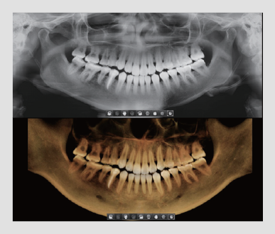 A 2D and 3D x-ray of a person's mouth in one view from the Vatech Smart Plus
