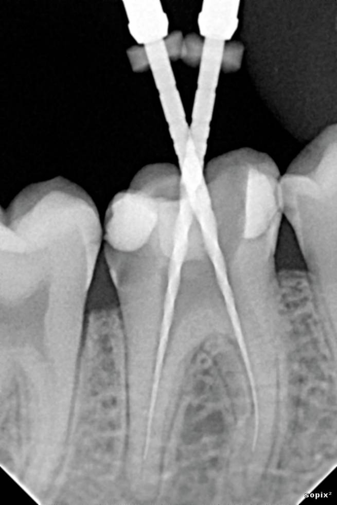 An x-ray of teeth using the Acteon SOPIX 2 sensor