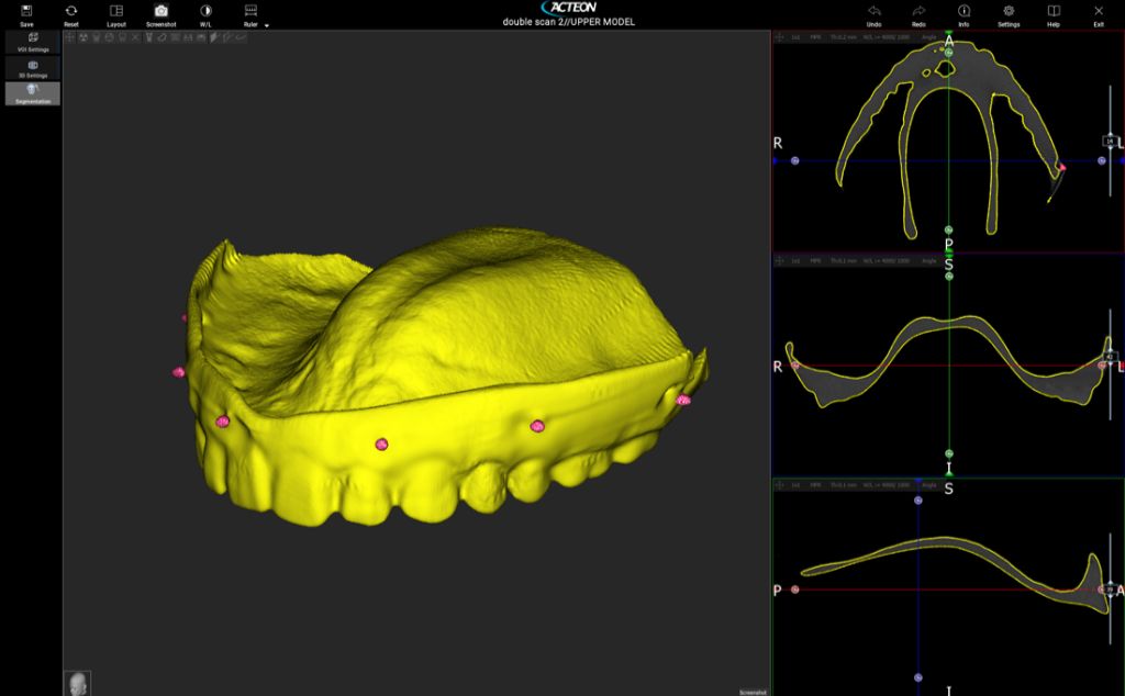 A 3D model image of a dental implant created using the Acteon X Mind Prime CBCT dental scanner