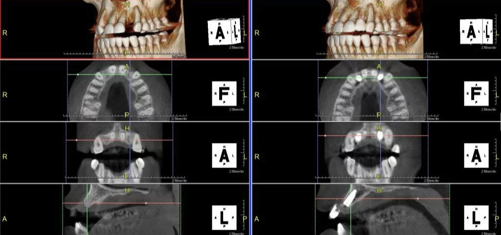 Multiple angles of an x-ray of a person's jaw from the PreXion Excelsior CBCT