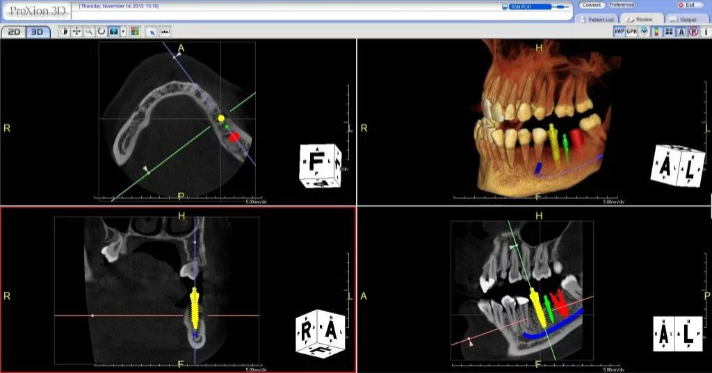 Several scans of a person's jaw showcasing the software used with the PreXion Excelsior CBCT x-ray