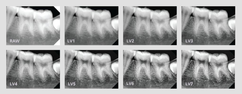 An x-ray of a person's teeth using the different contrast filters from the VaTech HD Sensor