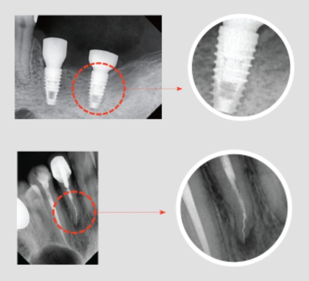 A dental x-ray showcasing the VaTech HD sensor's image processing capabilities