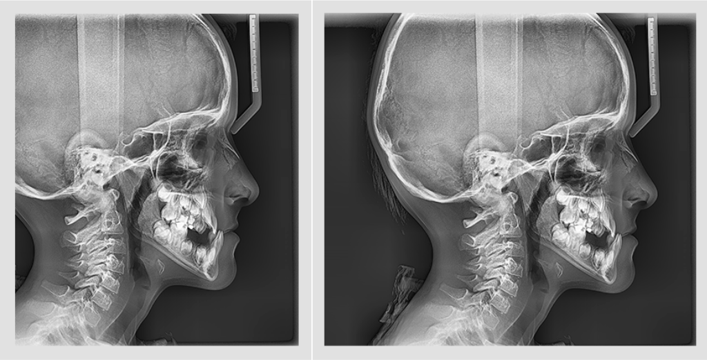 A side by side x-ray comparison of a person's head using the lateral view and full lateral view from the Vatech PaX-i x-ray machine