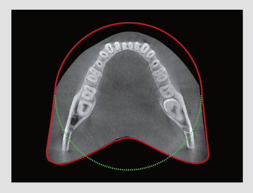 A top view of an x-ray of a person's mouth using the vatech smart plus extended arch pov